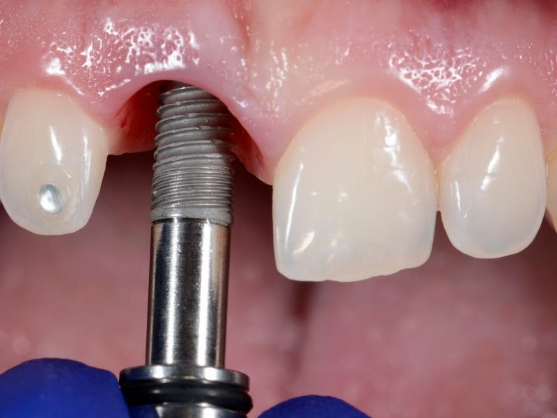 zirkonyum-implant-nasil-yapilir