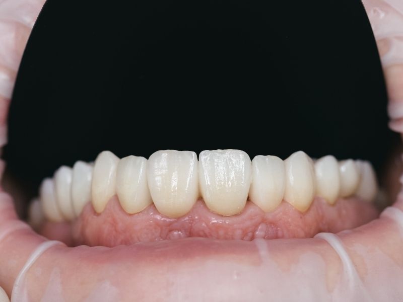 zirkonyum-implant-nedir