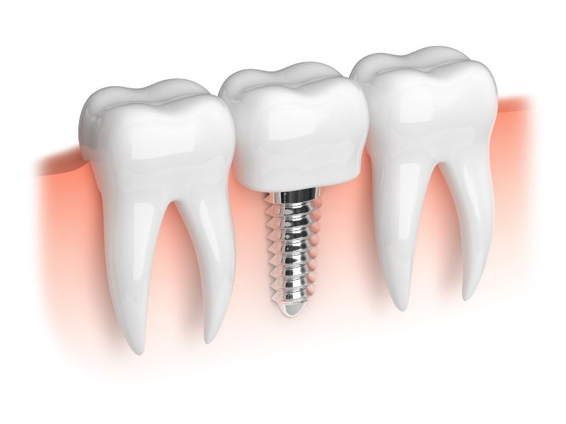zirkonyum-implantin-farki